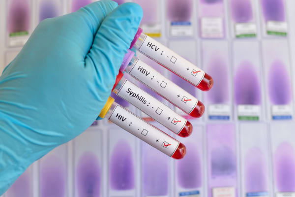 Blood sample positive with sexually transmitted diseases HIV, HBV, HCV, Syphilis